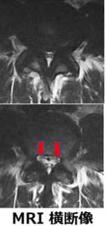 MRI脊柱管狭窄症
