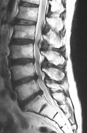MRI 腰部脊柱管狭窄症
