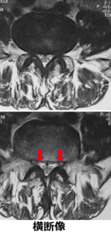 MRI 脊柱管外側狭窄症