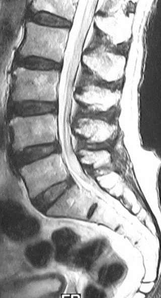 腰椎MRI矢状断