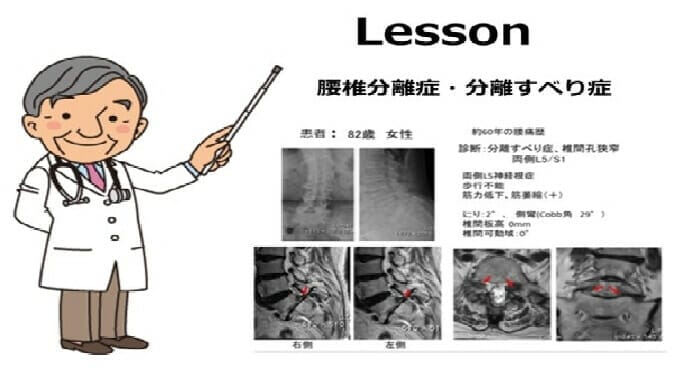 腰椎分離症・分離すべり症