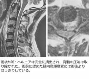 頚椎椎間板ヘルニア　C3/4 術後MRI