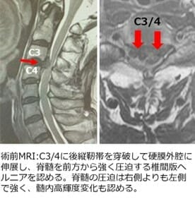 頚椎椎間板ヘルニア　C3/4 術前MRI