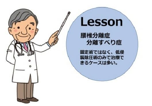 腰椎分離すべり症に対する低侵襲除圧術